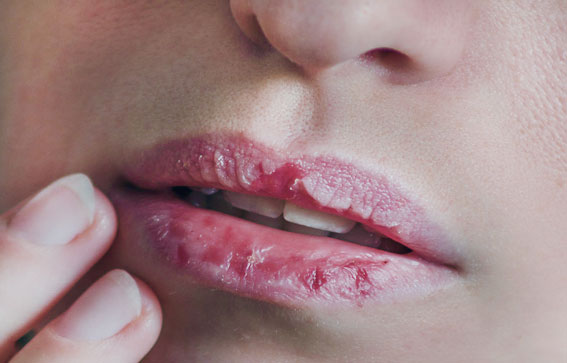 طرق تجنبك ظهور تشققات الشفاه&nbsp;