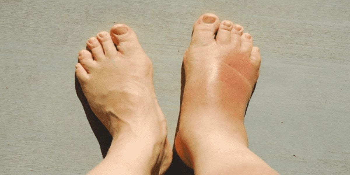 التهاب الأنسجة الدهنية