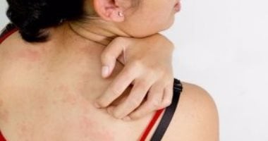 علاج الكانديدا&nbsp;