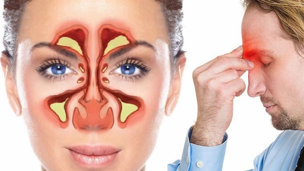 علاج التهاب الجيوب الأنفية