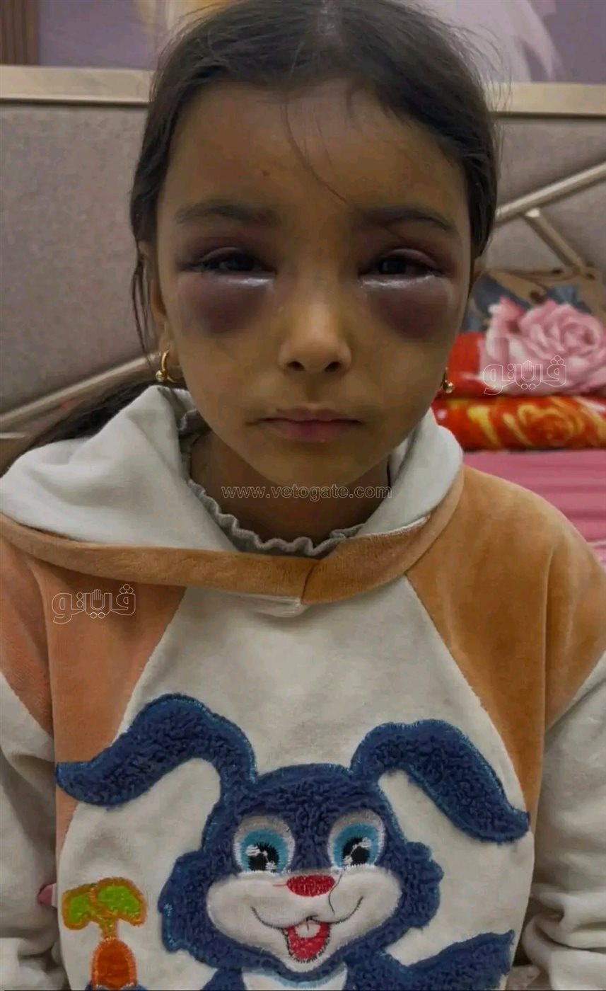 تعذيب طفلين،فيتو