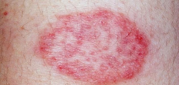 نصائح تجنبك فطريات الجلد&nbsp;