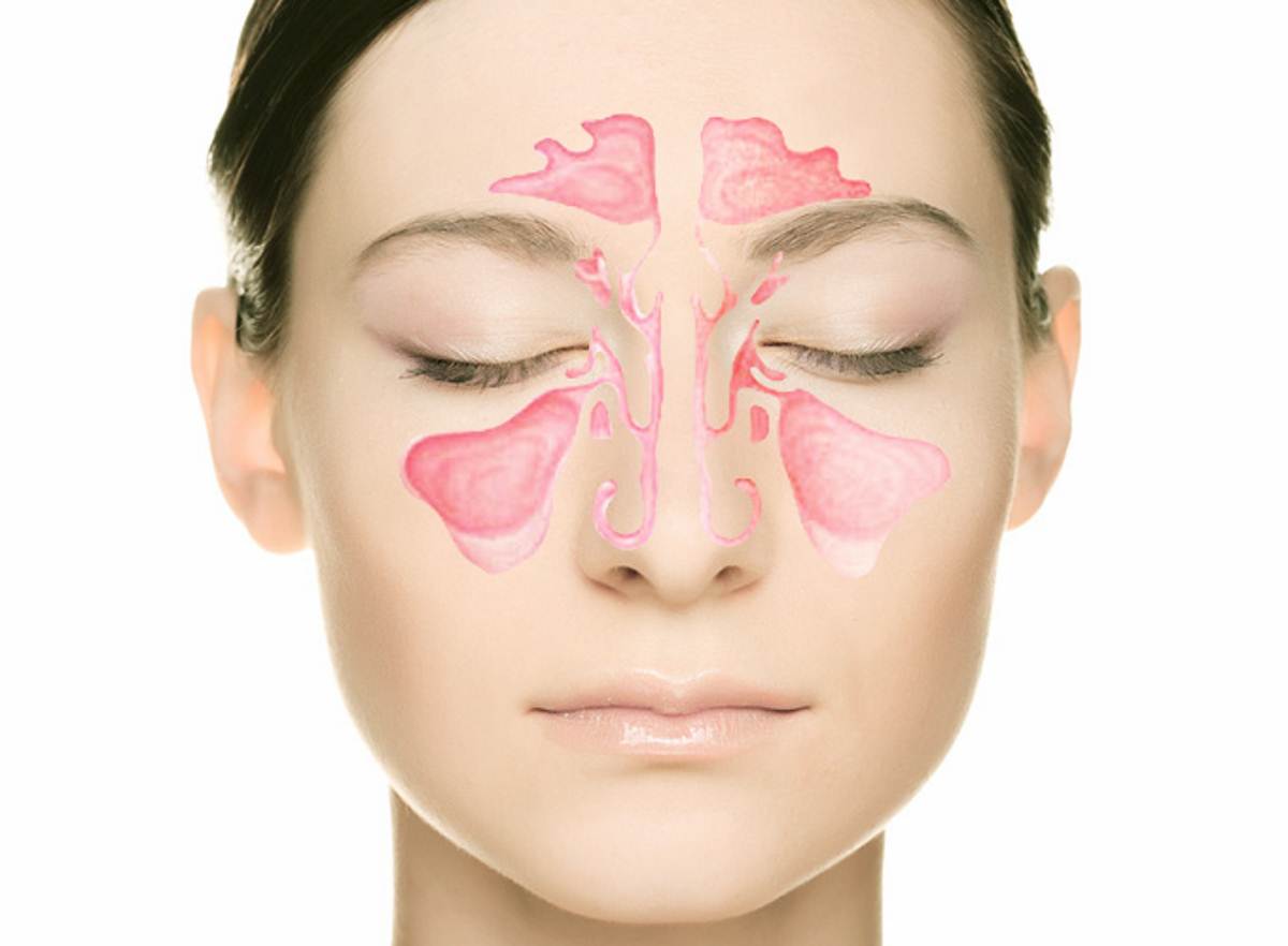 أعراض التهاب الجيوب الأنفية