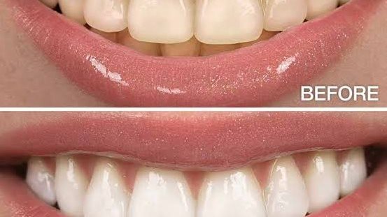 تبييض الاسنان