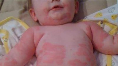 الفرق بين حساسية اللبن واللاكتوز