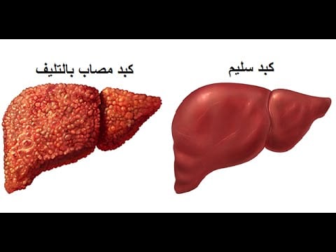 5 علامات صباحية تؤكد الإصابة بتليف الكبد