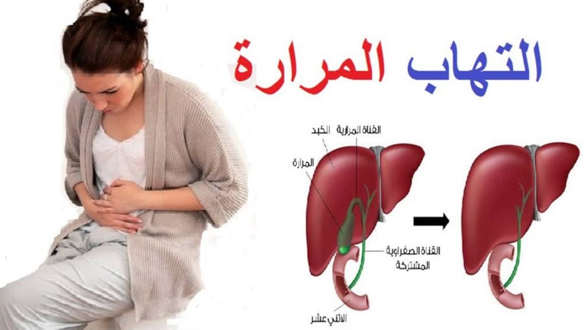 المرارة عند النساء