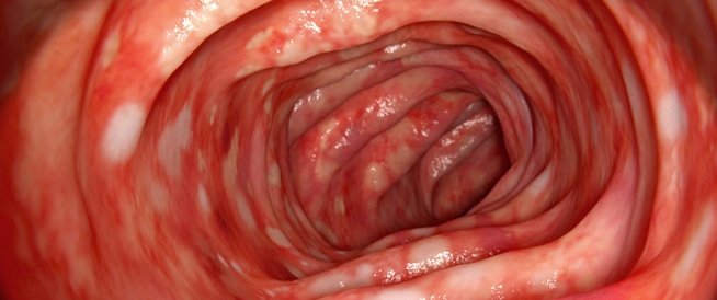وصفة طبيعية لعلاج التهاب القولون&nbsp;