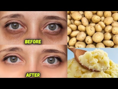 ماسك البطاطس للهالات السوداء