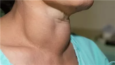 هل الكيتو دايت مناسب لمرضى الغدة الدرقية