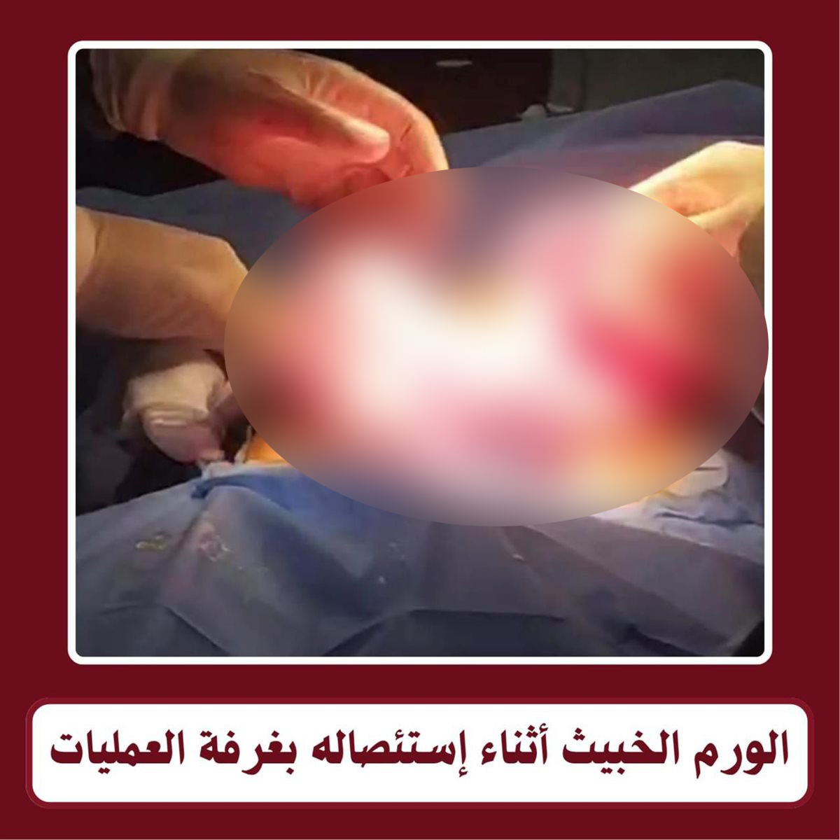 رئيس جامعة طنطا يعلن نجاح فريق طبي في استئصال ورم خبيث يزن ٢ كجم من طفلة بعمر ١٠ سنوات
