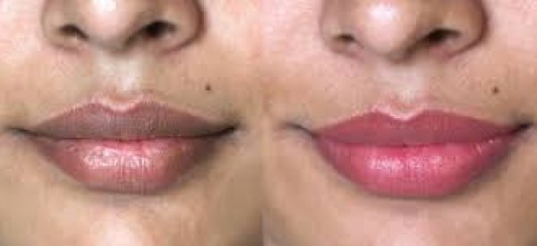 طرق التخلص من الاسمرار حول الفم