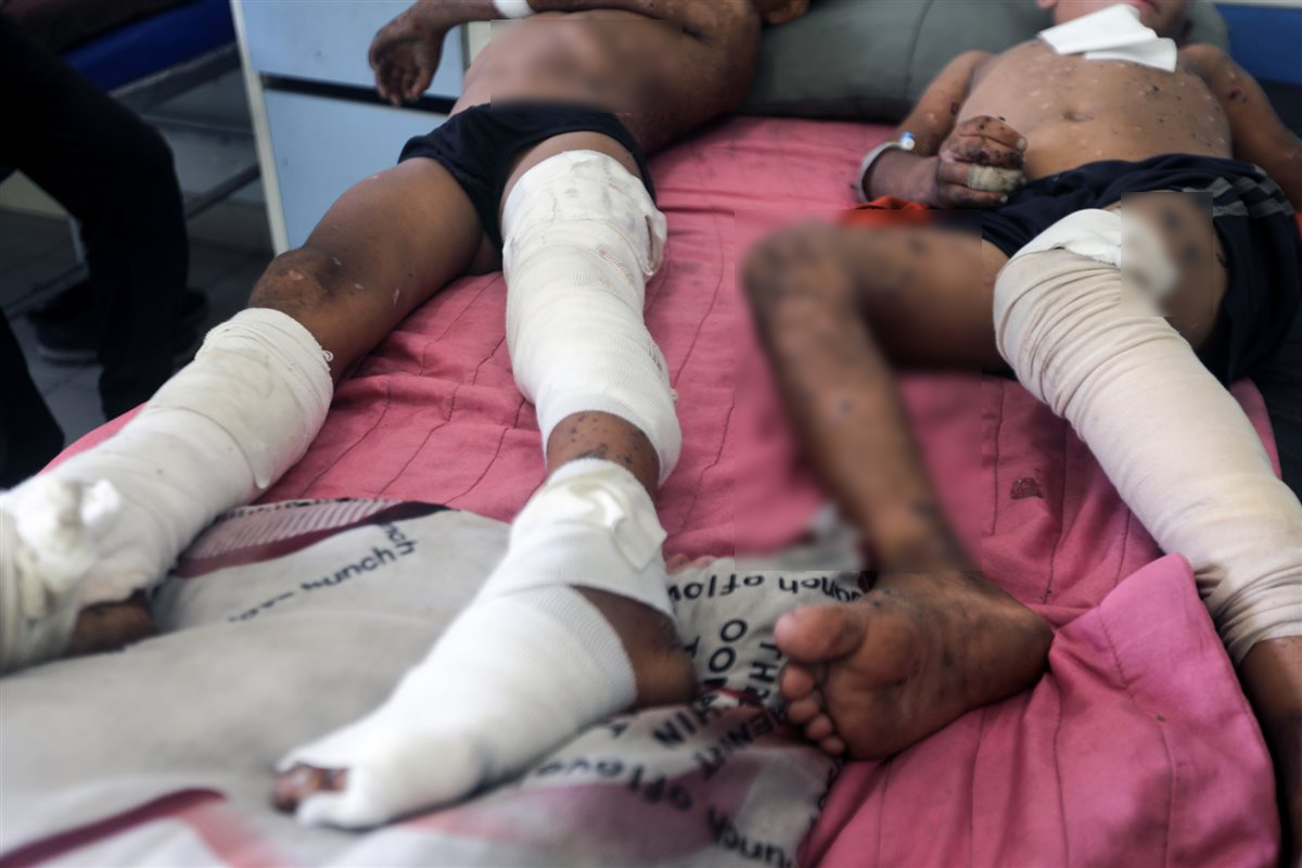 طفلان فلسطينيان يتلقيان العلاج من إصابات بالغة جراء انفجار ناجم عن ذخائر إسرائيلية غير منفجرة