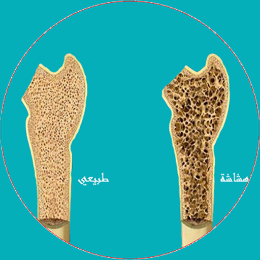 هشاشة العظام