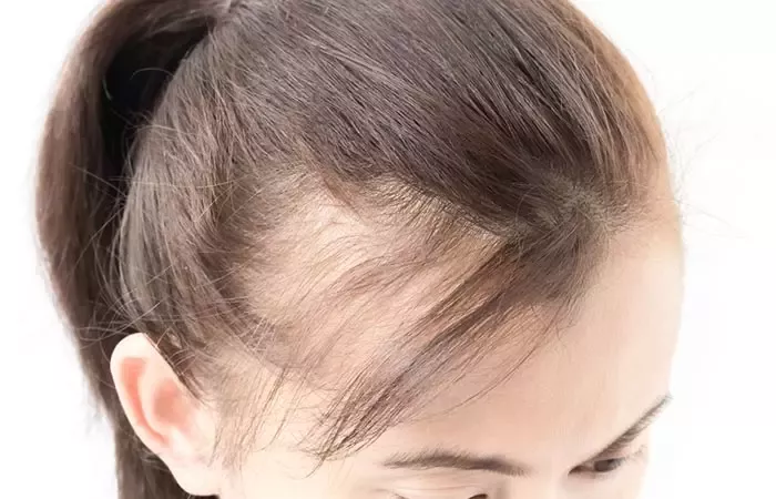 علامات ضعف بصيلات الشعر