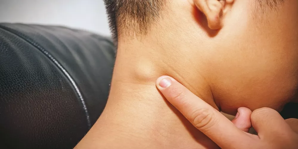 أسباب ظهور كلكوعة فى رقبة الطفل 