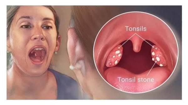أعراض وأسباب حصوات اللوزتين وطرق العلاج&nbsp;
