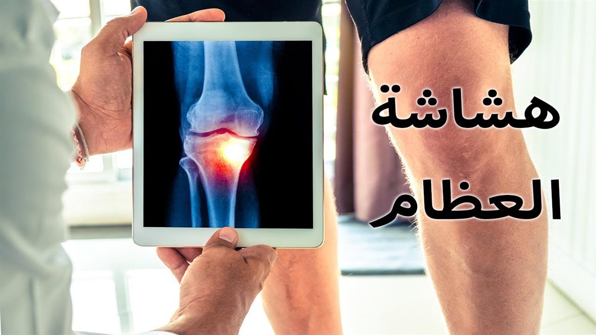 أعراض هشاشة العظام المبكرة