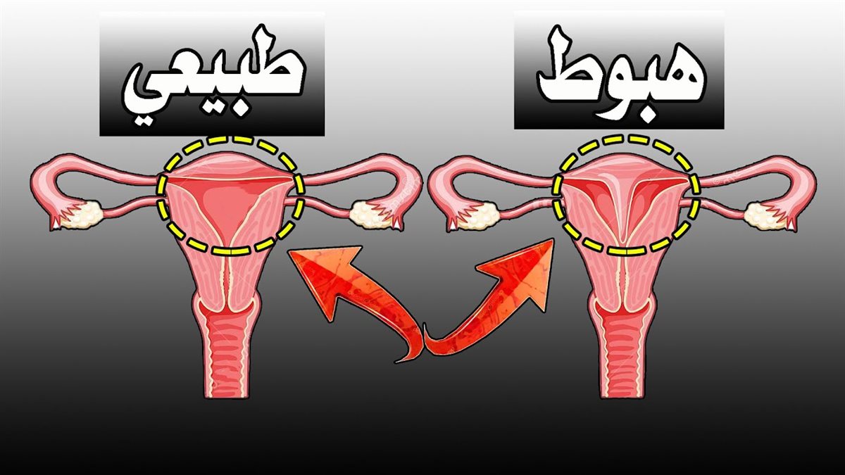 أعراض وأسباب السقوط الرحمى وطرق العلاج