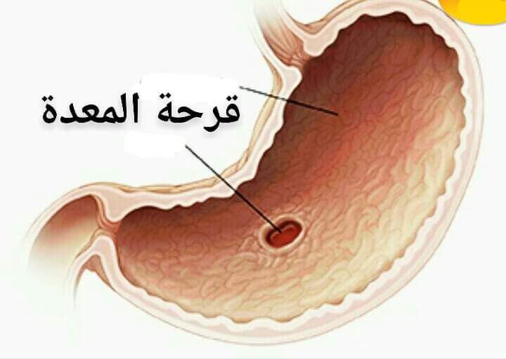 قرحة المعدة