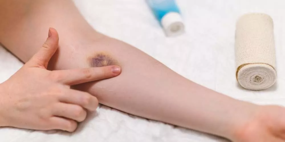 أعراض نقص الصفائح الدموية وأسباب الإصابة بها
