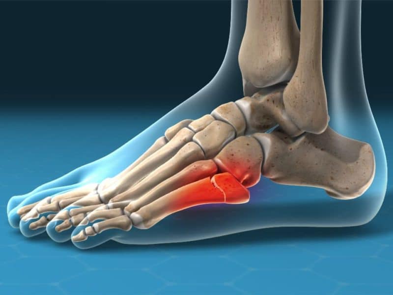 أعراض الشوكة العظمية وأسباب الإصابة بها