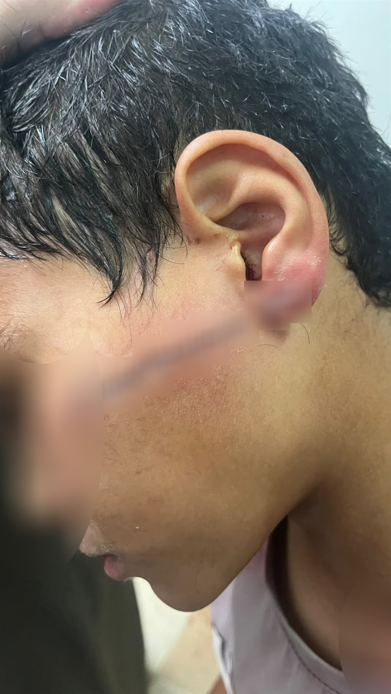 85 غرزة في وجه ورأس تلميذ، مشادة بين طفلين على باب مدرسة تنتهي بمأساة (صور ومستندات)