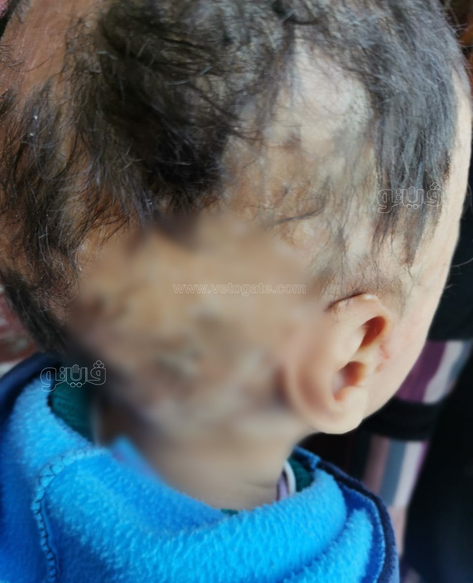 طفل اصيب بالحروق