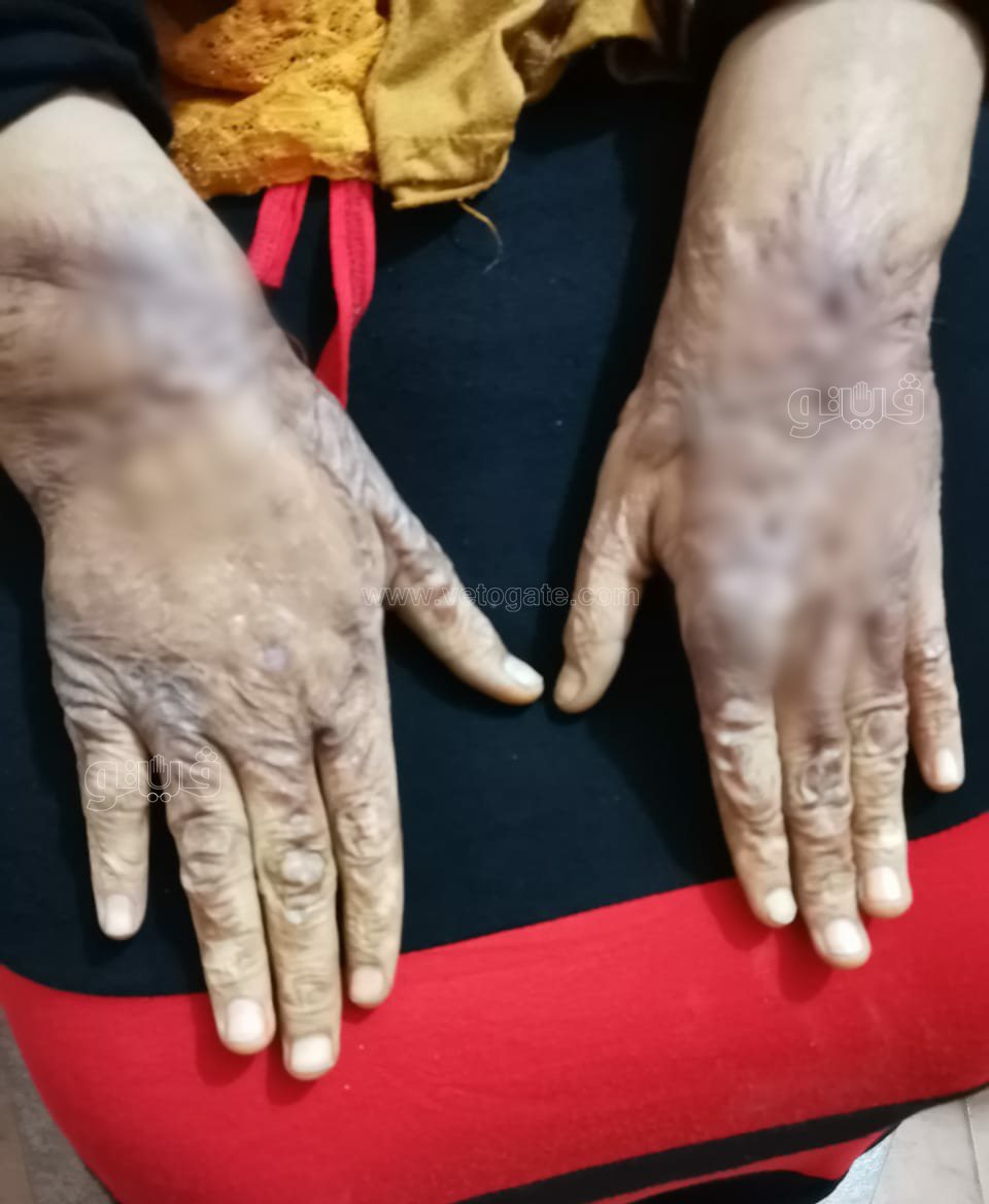 سيدة اصيبت بالحروق (3)