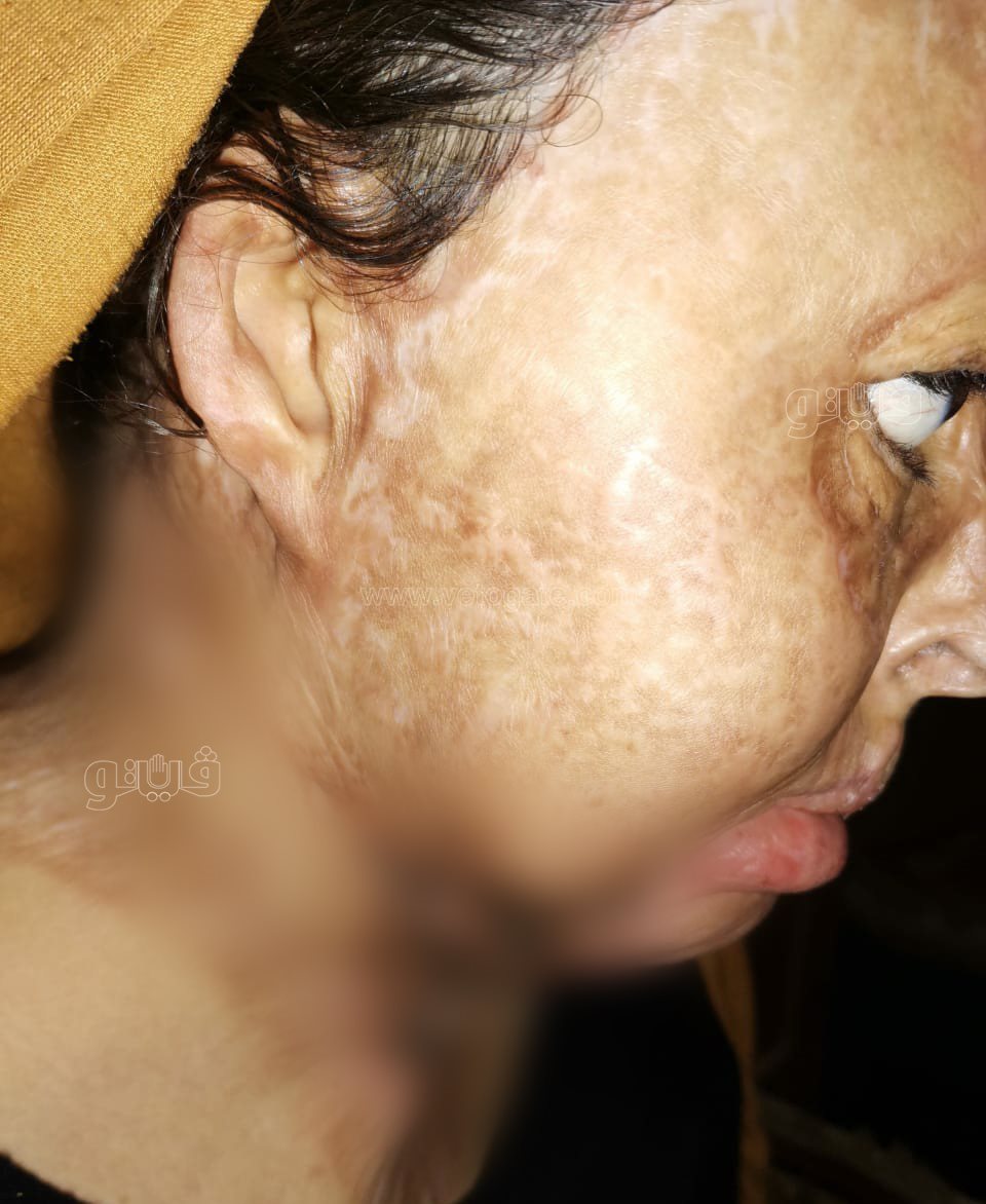 سيدة اصيبت بالحروق (1)