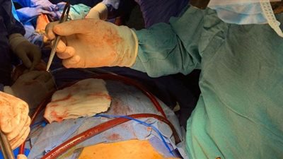 نجاح عملية استبدال وإصلاح الصمام الأورطى لثلاثة مرضى بمستشفى المنصورة | صور