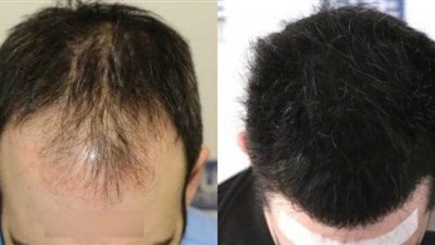 ما المنطقة المانحة في عملية زراعة الشعر الطبيعي بالاقتطاف؟.. استشاري يجيب
