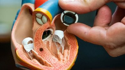 اليوم.. استئناف دعوى إلغاء تصالح محتكري صمامات القلب مع حماية المنافسة