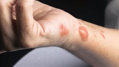 استشاري تجميل يوضح طرق علاج آثار الجروح والحروق