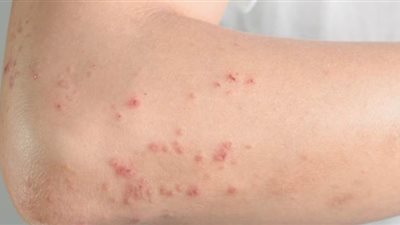 9 أعراض للإصابة بحساسية البرد