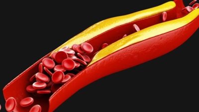 6 نصائح لعلاج دهون الدم الضارة