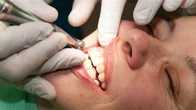 استخدامات الحشوات التجميلية للاسنان ومميزاتها