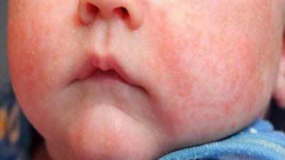 6 نصائح تساعد فى علاج طفلك من حمو النيل