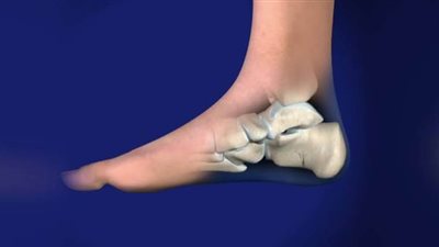 ما هي الشوكة العظمية وعلاجها