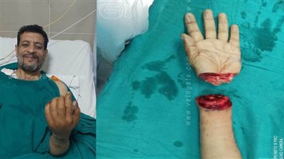 بعد ٨ ساعات.. فريق طبى بمستشفى أبوقير ينجح في إعادة كف مريض سكر بترت بمشاجرة | صور