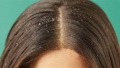 3 وصفات من مطبخك تخلصك من قشرة الشعر بدون مجهود ولا تكاليف