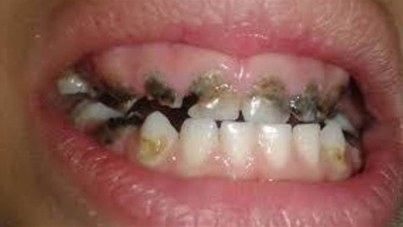 تسوس الاسنان في المنام