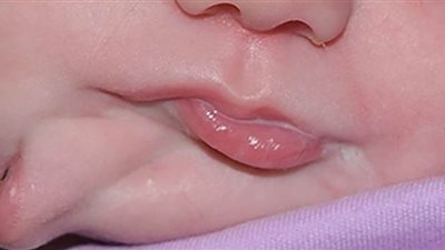 حدث نادر.. ولادة طفلة بفمين ولسانين| صور