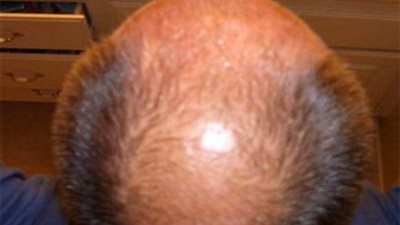 أسباب وعلاج التهابات بصيلات الشعر