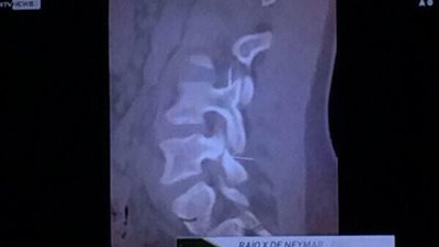 ننشر صورة أشعة الرنين للبرازيلي «نيمار» عقب إصابته بالمونديال