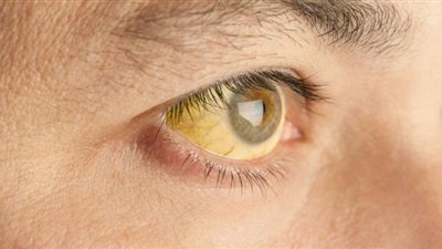 تعرف على الأسباب التي تؤدي إلى الإصابة بالحمى الصفراء