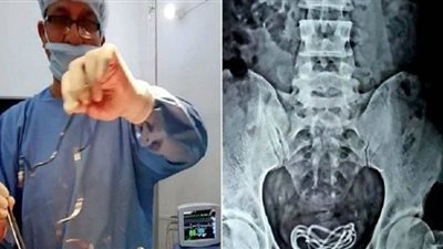 أغرب عملية جراحية.. إزالة شاحن هاتف طوله 60 سم من مثانة شاب