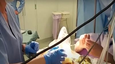 فيديو يحبس الأنفاس لإيطالية تطبخ أثناء خضوعها لجراحة في المخ