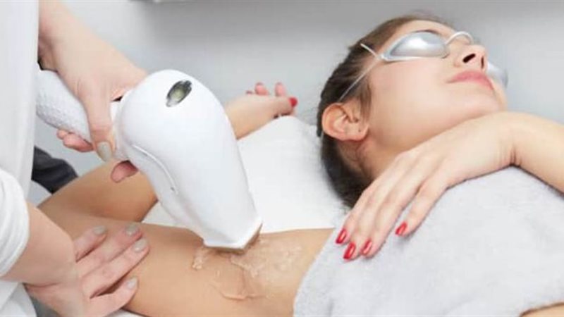 إزالة الشعر بالليزر