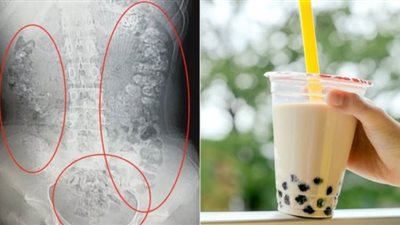 مراهقة تدخل في غيبوبة بعد شربها نوعاً من الشاي يوميا لمدة شهر!